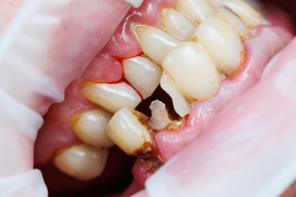 一口爛牙、滿口爛牙不處理會怎麼樣？影響外觀與全身健康
