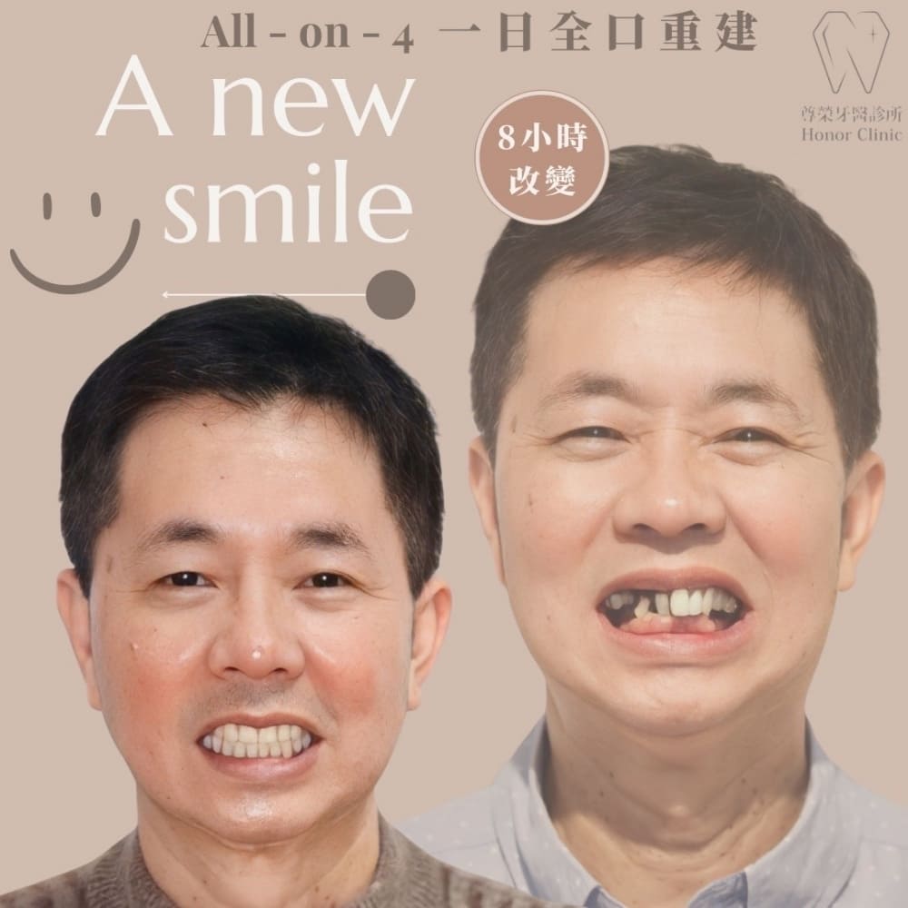尊榮牙醫診所的人工植牙成功案例