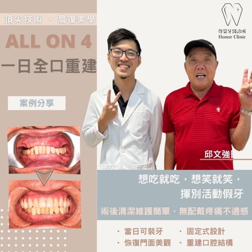 尊榮牙醫的全口植牙成功案例