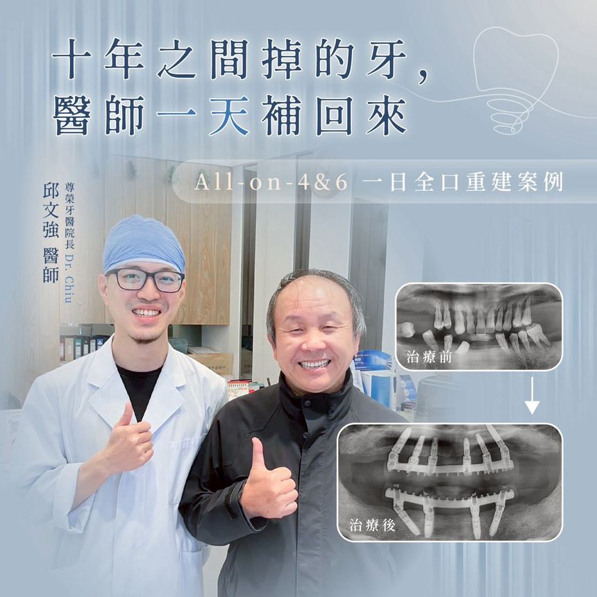 All on 6 上下顎全口重建案例：十年之間掉的牙，醫師一天補回來